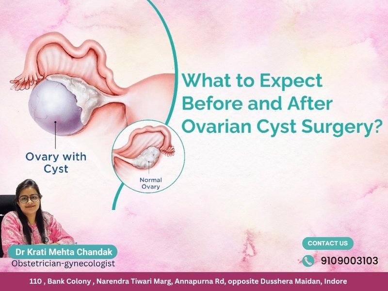 Dr. Krati Mehta Chandak – Best Gynecologist in Indore explaining what to expect before and after ovarian cyst surgery, showing diagram of normal ovary and ovary with cyst.